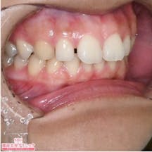 【歯】ホームホワイトニング マウスピース矯正_before