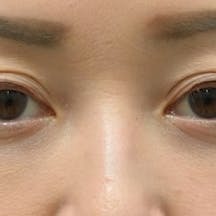 【女性・目元】目の下の切らないクマ・たるみ(ふくらみ)取り、ナチュラル脂肪注射コンデンスリッチ、ナチュラル脂肪注射ナノリッチ_after