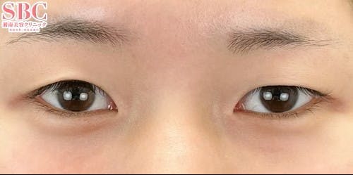 【10代女性・目元】クイックコスメティーク・ダブルNeo_before