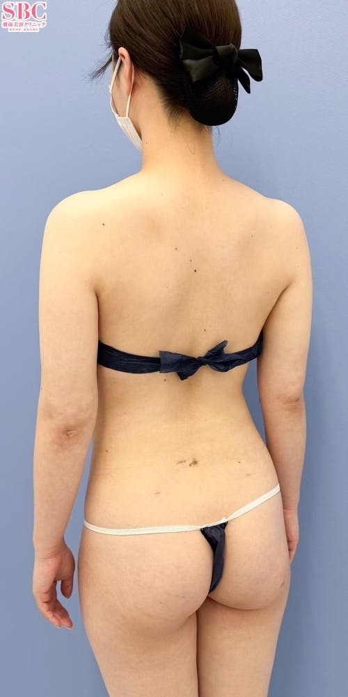 【女性・上半身】根こそぎVASER脂肪吸引、Aquicell（アキーセル）脂肪吸引_aftar