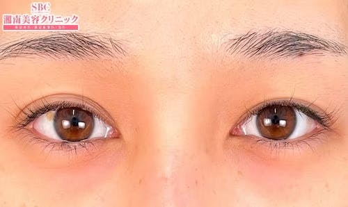 【女性・目元】クイックコスメティーク・ダブルNeo_before