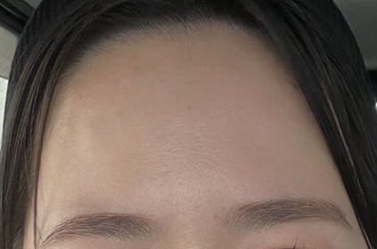 湘南美容クリニック 姫路院でボトックスを受けたまゆさんの写真