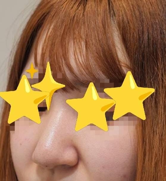 湘南美容クリニック 渋谷院で隆鼻術：鼻プロテーゼ修正を受けたぽっちさんの写真