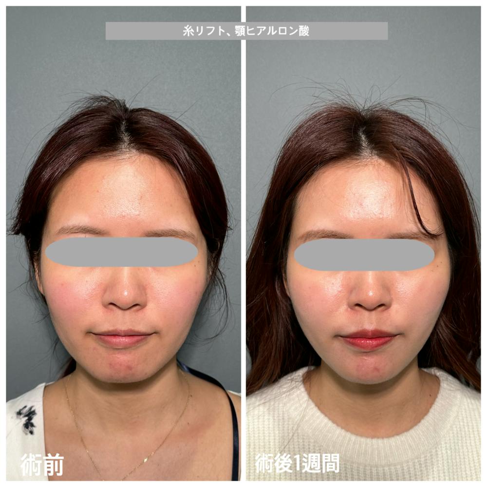 【30代女性・顔】PRISMリフト・あごのヒアルロン酸注射_before_aftar