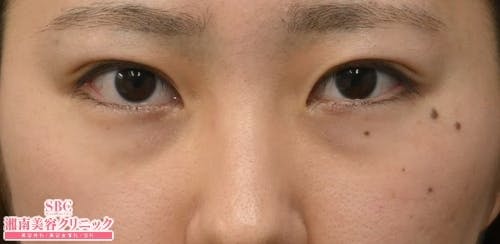 【20代女性・目元】目の下の切らないクマ・たるみ（ふくらみ）取り ナチュラル脂肪注射コンデンスリッチ ナチュラル脂肪注射ナノリッチ_before