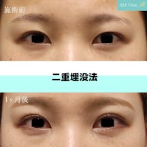 【女性・目元】二重埋没法_before_aftar