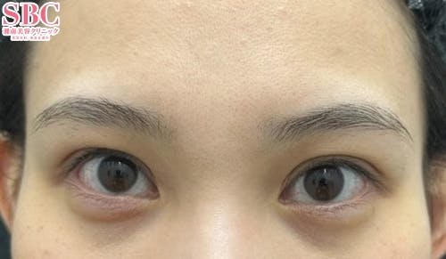 【20代女性・目元】週末二重(R)・ヒアルロン酸涙袋_after