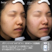 【女性・毛穴】ポテンツァ(ドラックデリバリー)BENEV_before_aftar