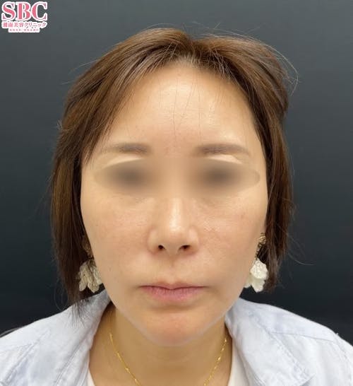 【40代女性・顔】プロファイロ_after