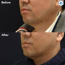 【男性・たるみ】脂肪溶解注射(あご下のたるみ)_before_aftar