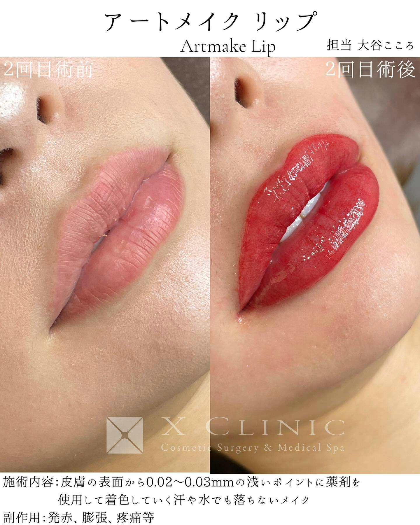 【女性・唇】リップアートメイク_before_aftar