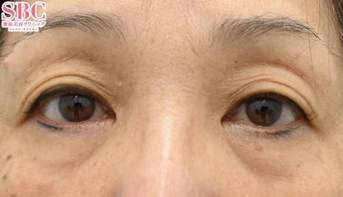 【60代女性・たるみ】アイバックリムーブ法 ナチュラル脂肪注射コンデンスリッチ_before