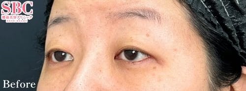 【40代女性・たるみ】タルミ取り併用全切開法二重・眼瞼下垂_before