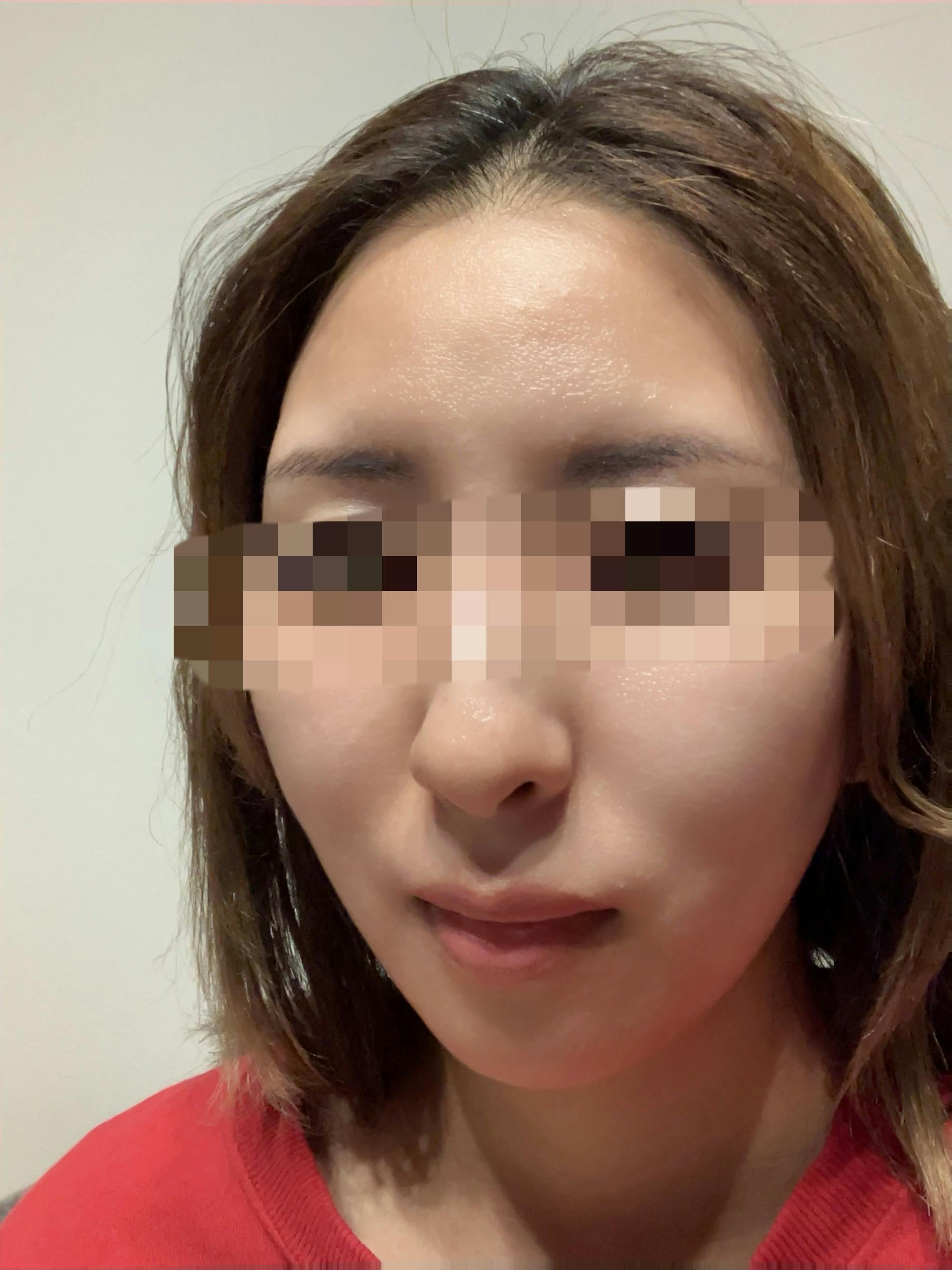 SSCビューティークリニックで傷跡修正アートメイクを受けたkoumeさんの写真