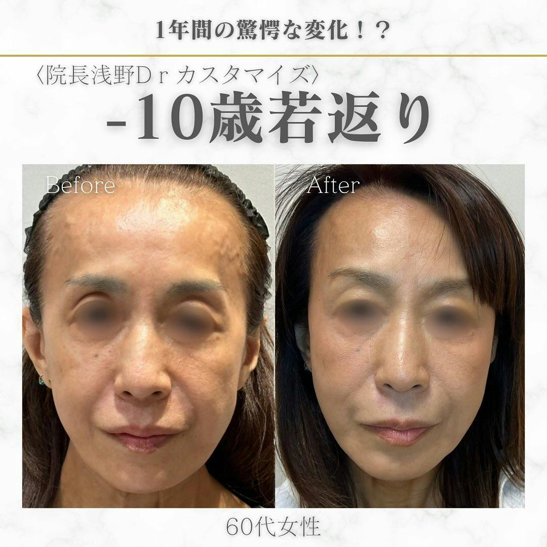 【女性60代・若返り】糸リフト_before_aftar