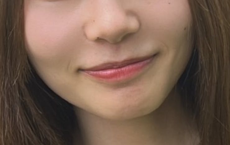 湘南美容クリニック 名古屋院でボトックス注射・エラボトックス注射(小顔)・韓国製ボトックス・ボツリヌストキシン・アラガン製ボトックスを受けたあいさんの写真