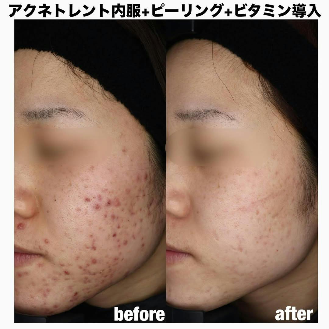 【女性・顔】アクネトレント＋ピーリング＋ビタミン導入_before_aftar
