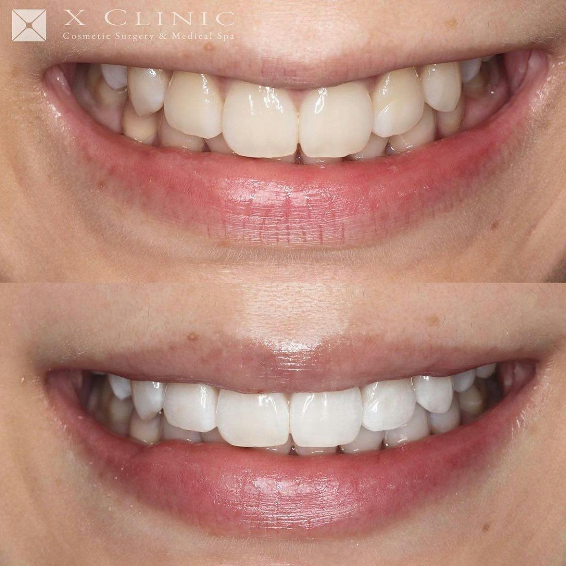 【女性・歯】オフィスホワイトニング_before_aftar