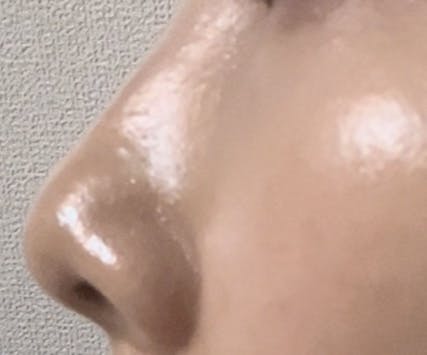 X CLINIC (エックスクリニック) 恵比寿院でヒアルロン酸注射・注入・ジュビダーム(ヒアルロン酸)・ボライトXC・ボリューマXC・ボリフトXC・ボルベラXC・ボラックスXCを受けたりりさんの写真