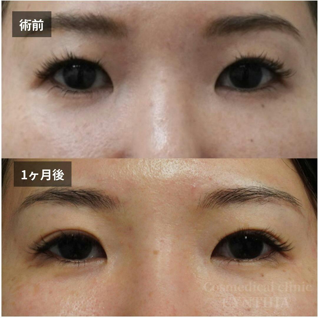 【30代女性・目元】セミプレミアムクイック法_before_aftar