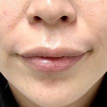 【女性・唇】ヒアルロン酸ジュビダームビスタ バイクロスシリーズ_before