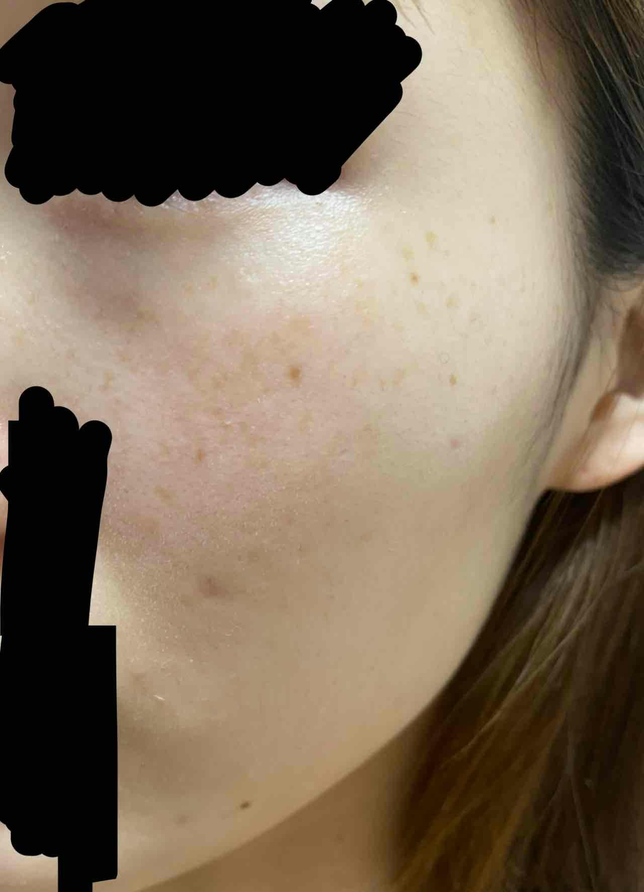 上野病院でピコスポットを受けたぴょんさんの写真