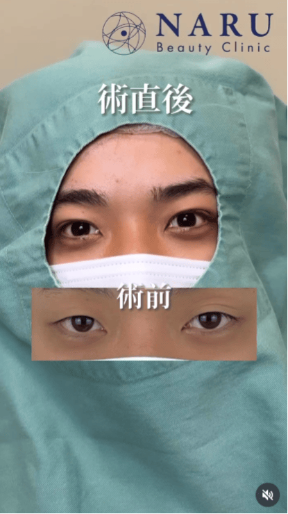 【男性・目元】二重埋没法_before_aftar