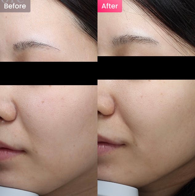 【女性・赤み】赤みや毛穴が気になる