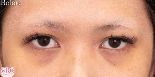 【30代女性・目元】目の下の切らないクマ・たるみ（ふくらみ）取り、ナチュラル脂肪注射コンデンスリッチ、ナチュラル脂肪注射ナノリッチ_before