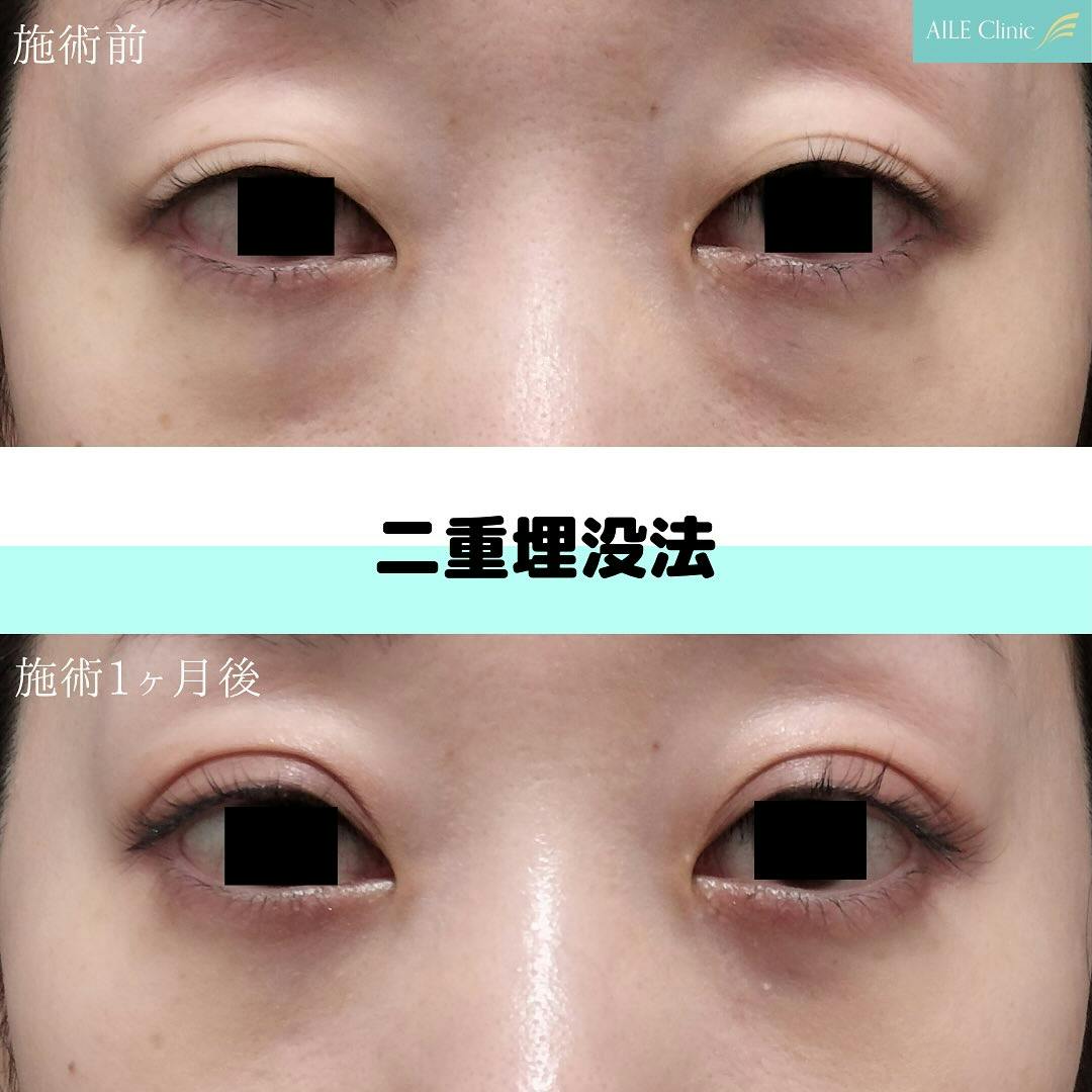 【女性・目元】二重埋没法_before_aftar