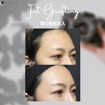 【女性・額】額の脂肪注入_before_aftar