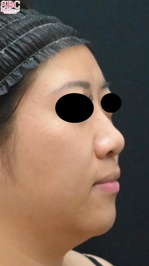 【女性・輪郭】ヒアルロン酸ウルトラディープ・ヒアルロン酸ジュビダームビスタ バイクロスシリーズ_before