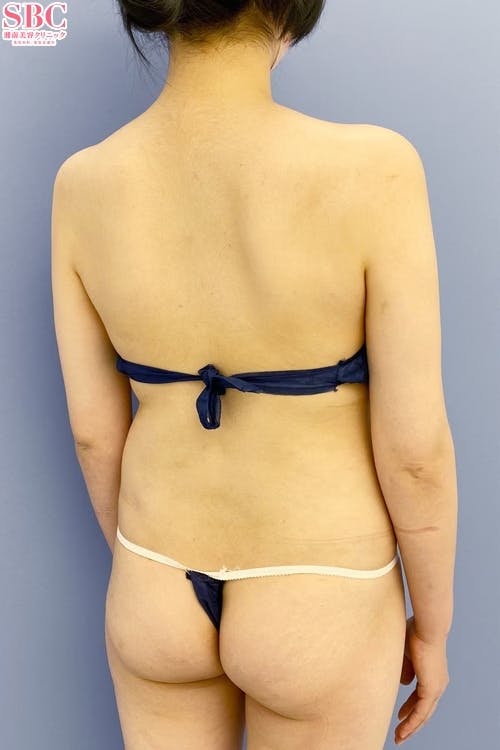 【女性・上半身】Aquicell（アキーセル）脂肪吸引、根こそぎVASER脂肪吸引_aftar