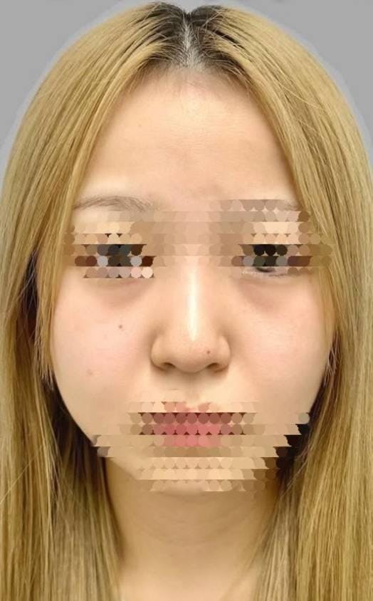 横浜TAクリニックで下眼瞼切開術（クマ・たるみとり）：眼輪筋吊り上げ（両目）を受けた田中さんの写真