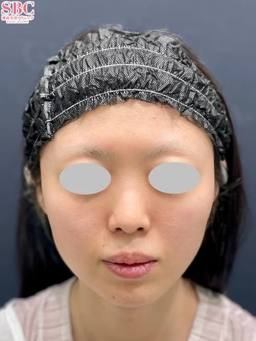 【20代女性・鼻】SBCプレミアムソフトプロテーゼ 鼻尖形成/鼻尖形成3D法（だんご鼻解消術） 鼻尖部軟骨移植_before