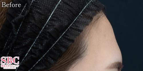 【30代女性・額】SBCプレミアムPRP皮膚再生療法_before