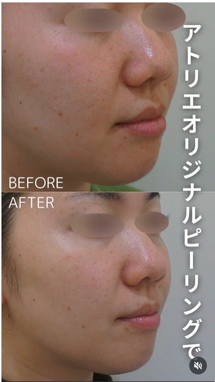 【女性・肌】エルメスピール ピコフラクショナル_before_aftar