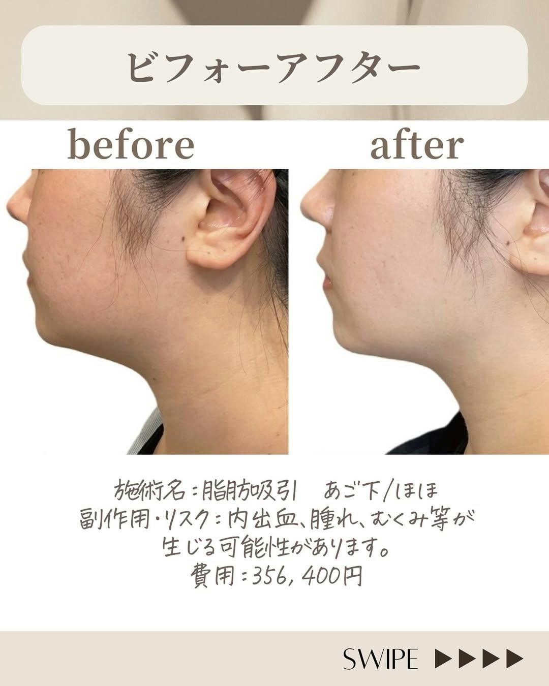 【女性・小顔】脂肪吸引_before_aftar