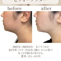 【女性・小顔】脂肪吸引_before_aftar