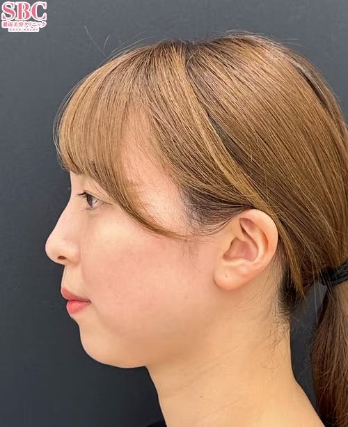 【20代女性・顔】Aquicell(アキーセル)脂肪吸引・ジョールファット除去術・エンブレイスRF_before