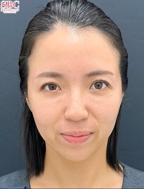 【女性・目元】裏ハムラ法 VOV（ボブ）リフト テスリフト_aftar