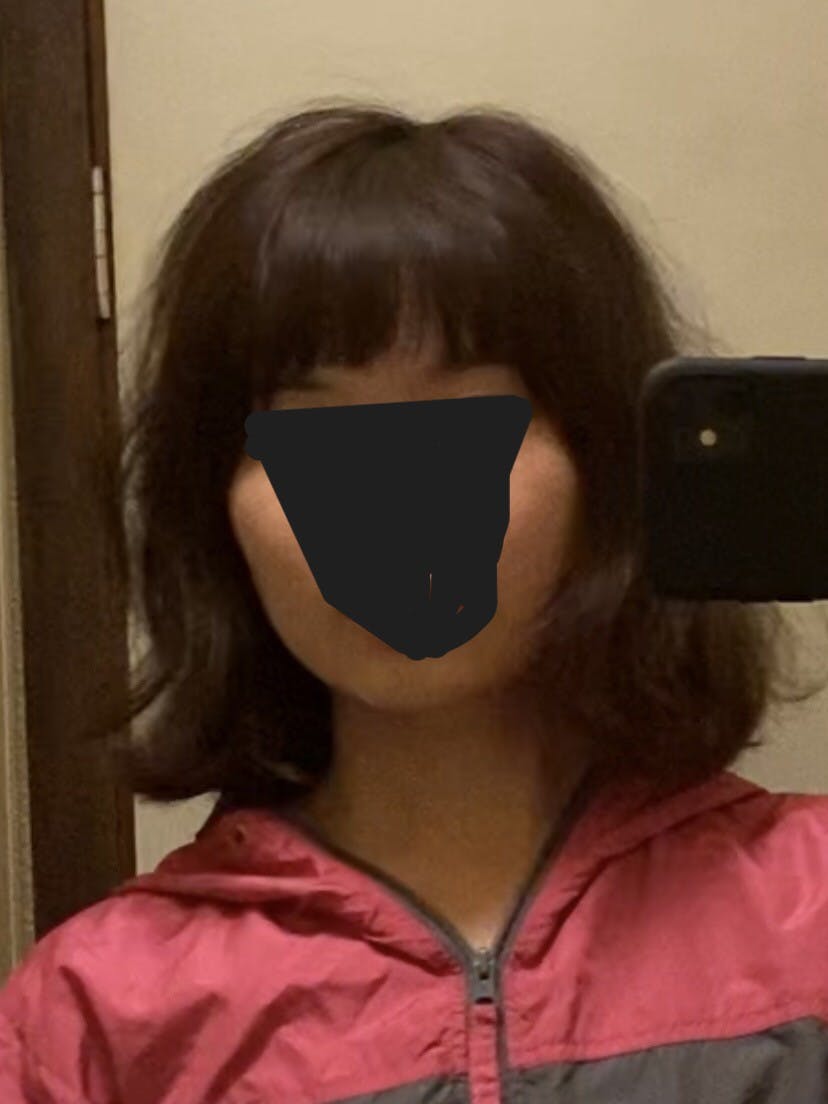 湘南美容クリニック  大阪梅田院でウルトラリフトプラスHIFUを受けた山藤さんの写真