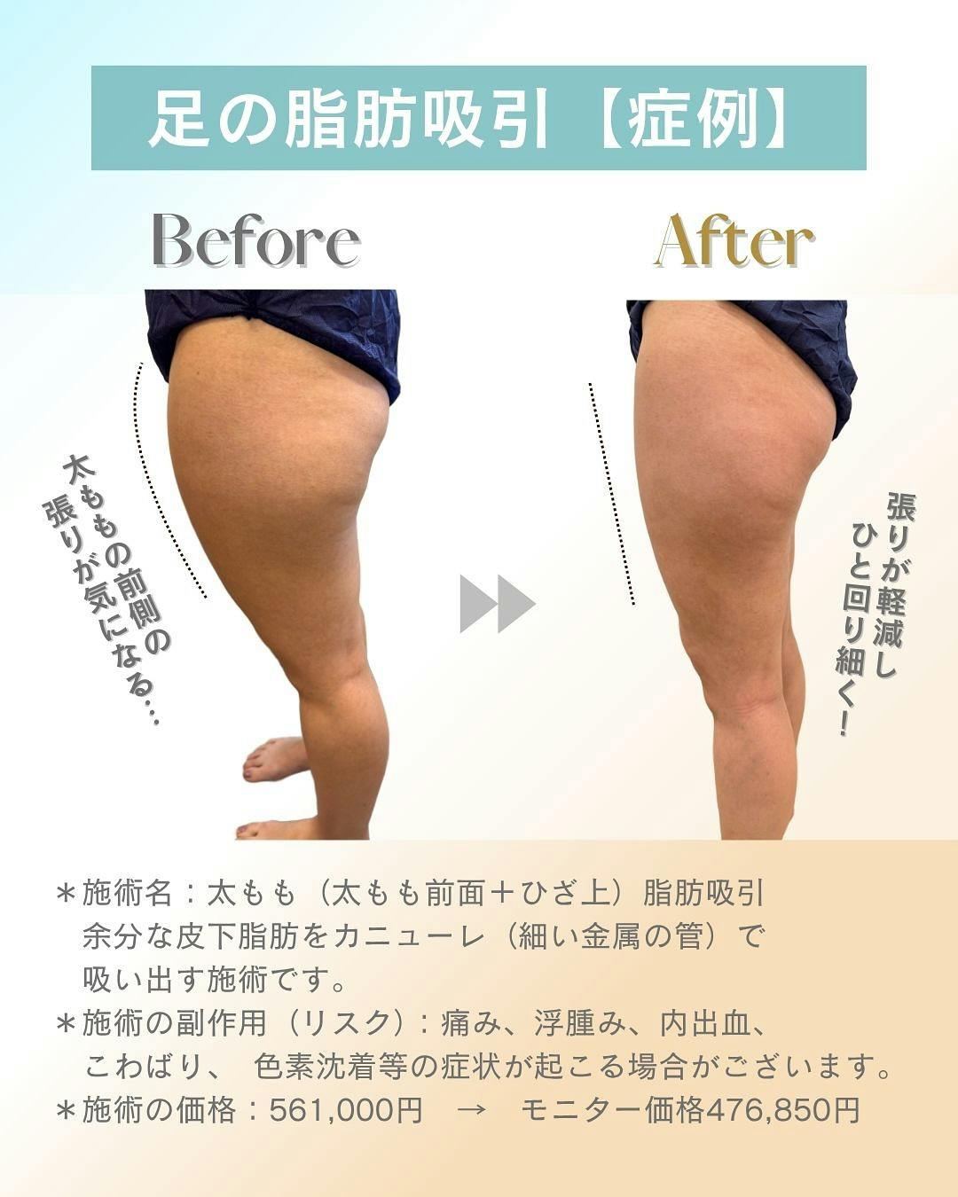 【女性・美脚】脂肪吸引_before_aftar