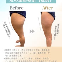 【女性・美脚】脂肪吸引_before_aftar