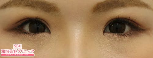 【女性・目元】全切開法二重術、目頭切開プレミアム_aftar