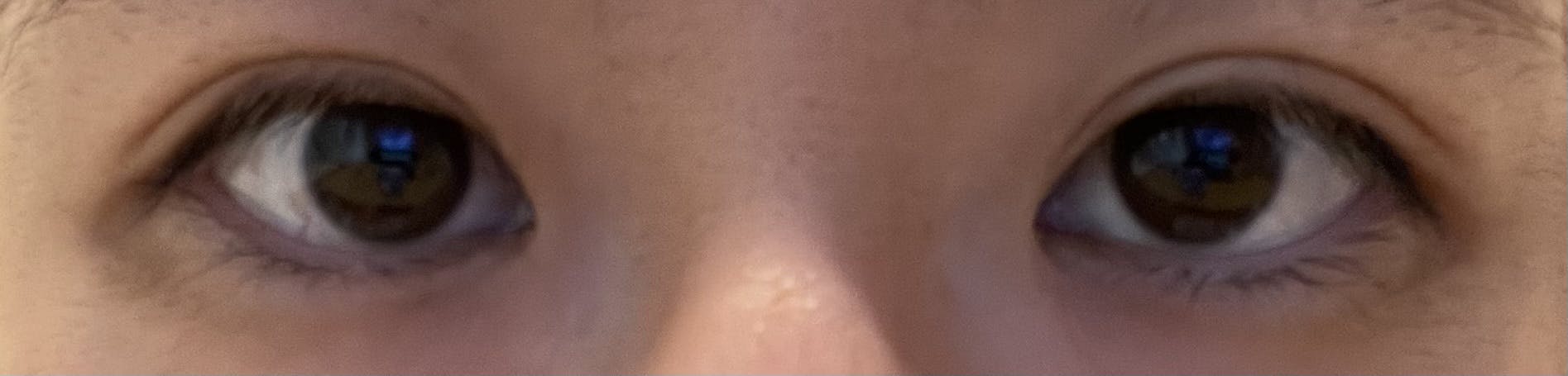 品川美容外科 名古屋院でスーパーナチュラル二重術切開法ロングを受けたのんさんの写真