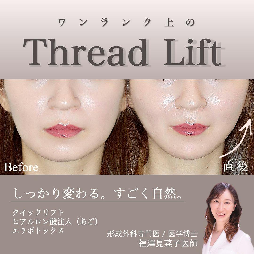 【女性・輪郭】糸リフト_before_aftar