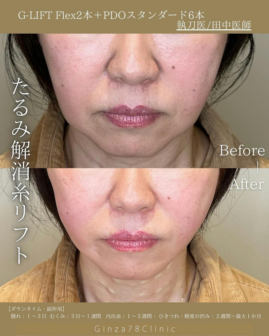 【女性・たるみ】糸リフト_before_aftar