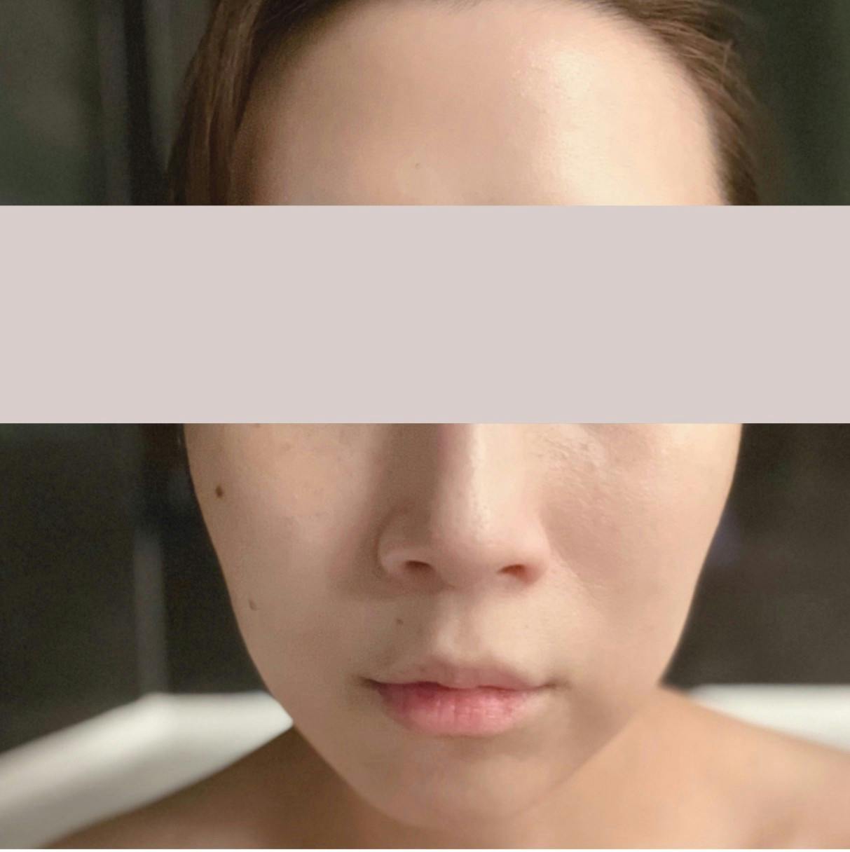 湘南美容クリニック 池袋メトロポリタン口院でを受けたmimimiさんの写真