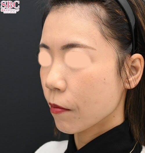 【女性・凹凸】ナチュラル脂肪注射コンデンスリッチ、VOV（ボブ）リフト_after